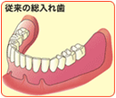 従来の総入れ歯