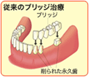 従来のブリッジ治療