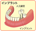 インプラント2