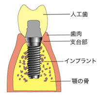 インプラント治療